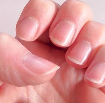 Kenali Masalah Kesehatan Lewat Kondisi Kuku