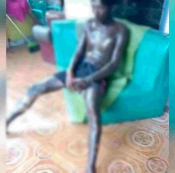 Mandi Pakai BBM Premium, Warga Takalar Alami Luka Bakar Serius