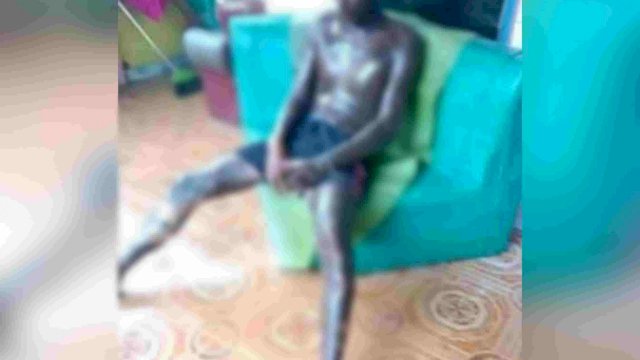 Kondisi Safaruddin, warga Dusun Galumbaya, Desa Ujung Baji, Kecamatan Sanrobone, Kabupaten Takalar, yang mengalami luka bakar serius setalah mandi menggunakan BBM jenis Premium.