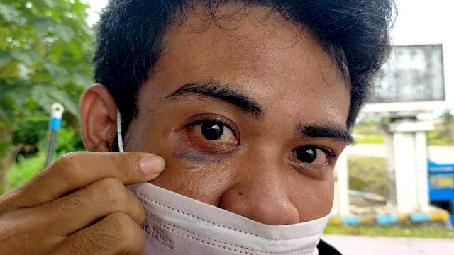 Korban yang dibacok oleh pelaku saat dirinya nongkrong bersama temanya di pinggir jalan. Mata korban nyaris buta akibat kejadian tersebut.