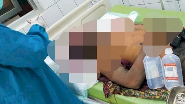 Agus Salim (35) korban penganiayaan oleh adik kandung sendiri menjalani perawatan di RSUD dr Murjani Sampit. (Ist)