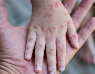 Kemenkes Konfirmasi Temuan Pertama Cacar Monyet di Indonesia