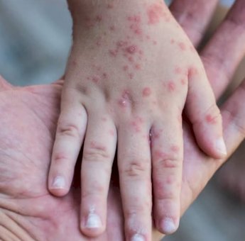 Kemenkes Konfirmasi Temuan Pertama Cacar Monyet di Indonesia