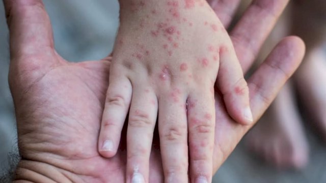 Cacar Monyet atau Monkeypox. (Foto: Istimewa)
