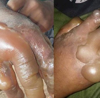 Guru STM di Flores Timur Paksa Siswa Celup Tangan di Air Panas Hingga Melepuh