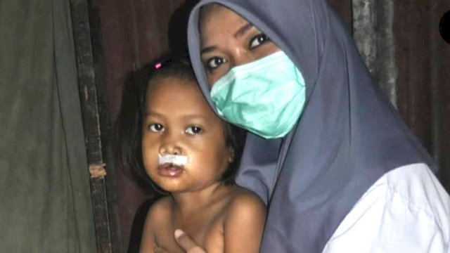Sulis bersama anak penderita bibir sumbing. (Istimewa)
