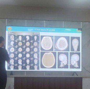 RS dr. Hasri Ainun Habibie Sukses Gelar Operasi Bedah Otak Perdana di Parepare