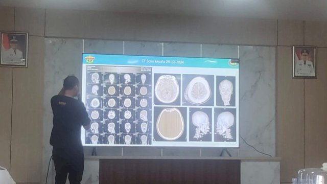 Ket: Operasi Otak di RS Hasri Ainun Habibie